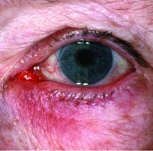 Subtype 4 ocular rosacea: Eye irritation: Watery or bloodshot appearance, irritation, burning or stinging.
